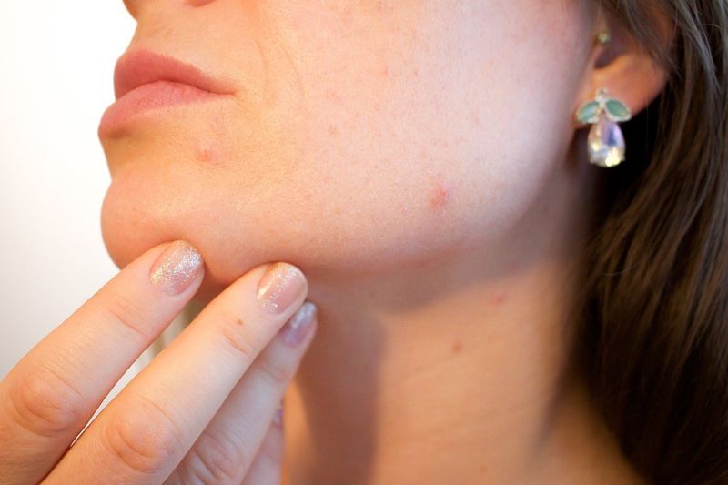 Skin Breakouts