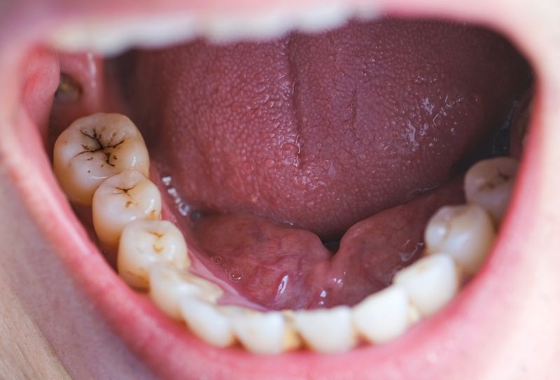 Tooth Decay