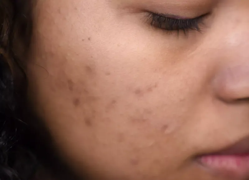 Frequent Skin Problems (Acne, Premature Aging)